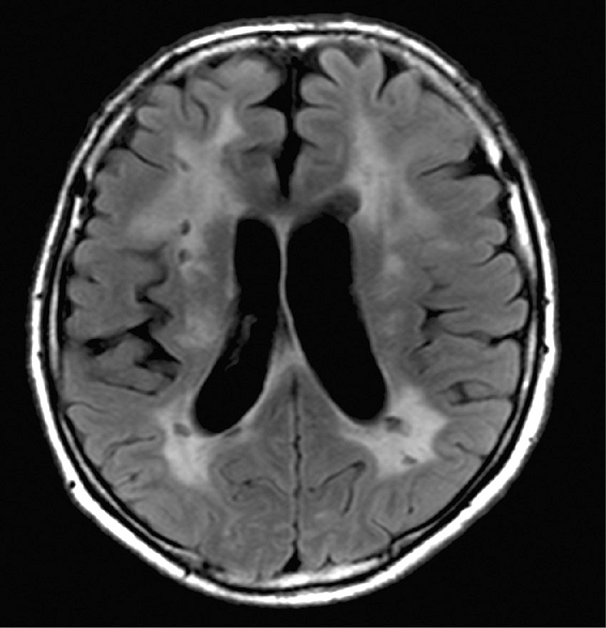 ⓔ図18-5-18　Fabry病による脳梗塞のMR像 