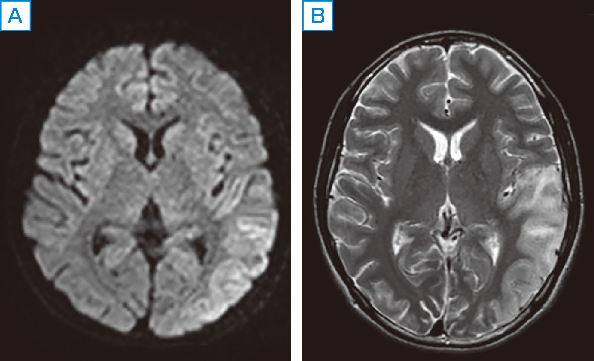 ⓔ図18-5-19　MELASによる脳梗塞のMR像 脳血管領域に一致しない病変がみられる．