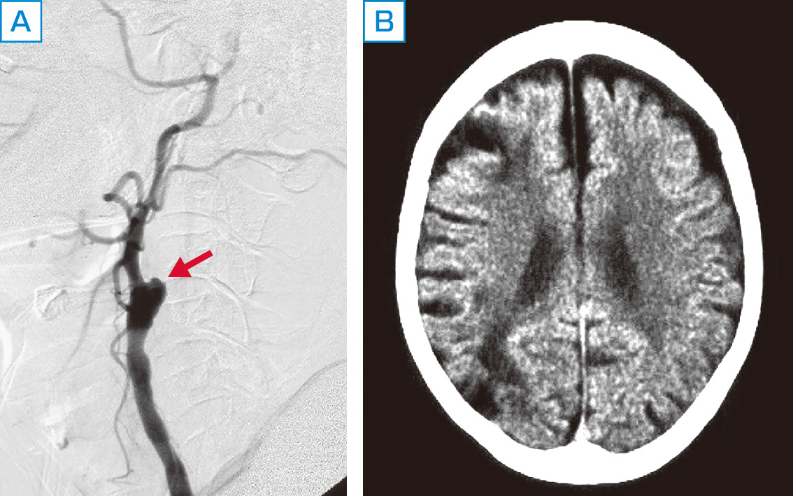 ⓔ図18-5-2　アテローム血栓性脳梗塞 (内頸動脈起始部閉塞) の画像所見 