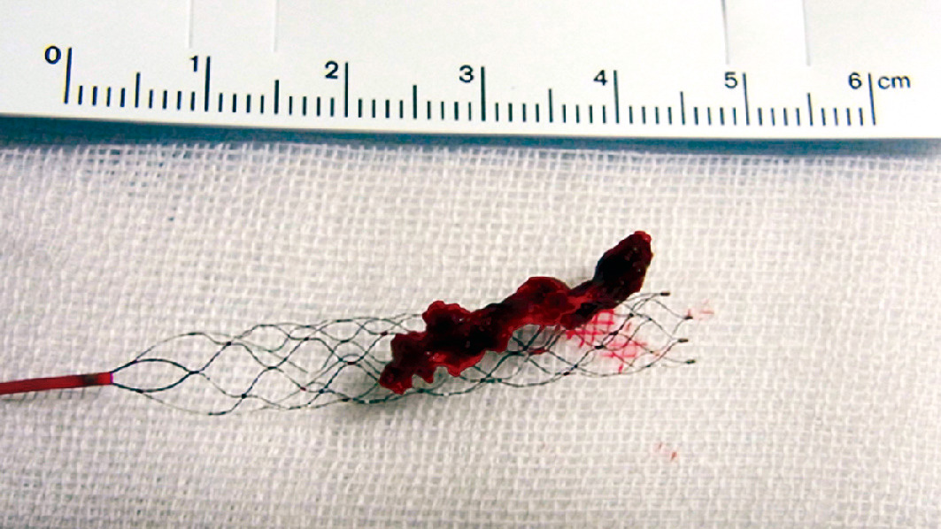 ⓔ図18-5-20　血栓回収療法で回収された血栓 