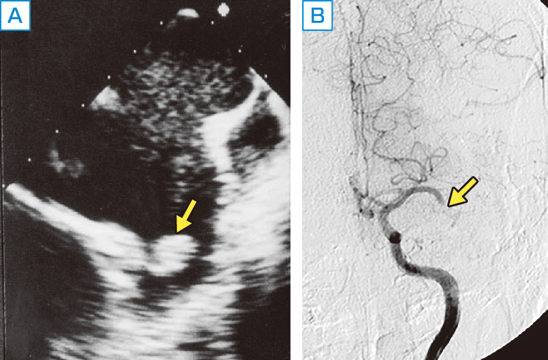ⓔ図18-5-4　心原性脳塞栓症の超音波像 (A) と血管造影像 (B) 