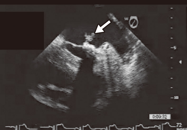 ⓔ図18-5-6　感染性心内膜炎の超音波像 