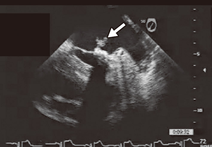 ⓔ図18-5-6　感染性心内膜炎の超音波像 