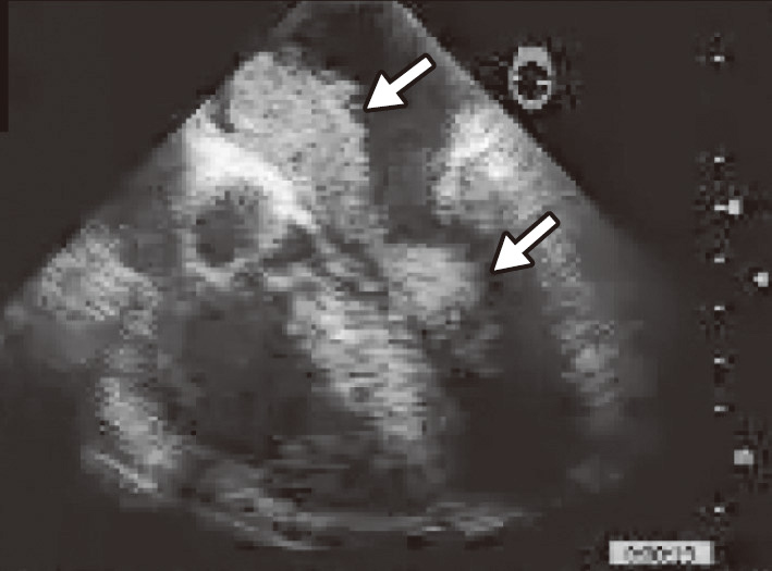 ⓔ図18-5-7　粘液腫の超音波像 
