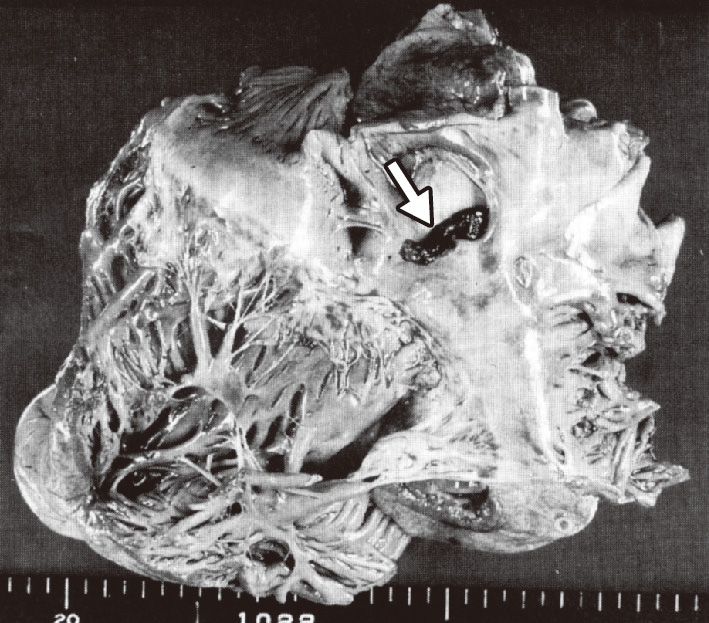 ⓔ図18-5-8　卵円孔を貫く血栓の剖検所見 