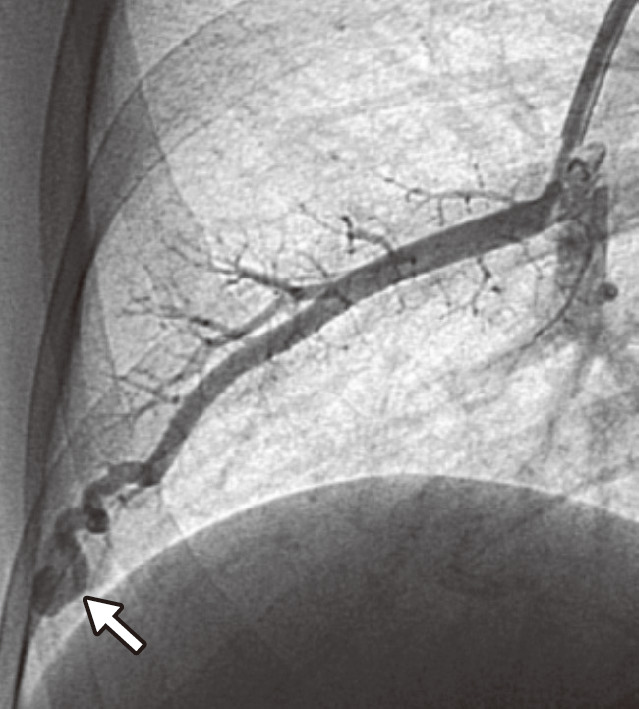 ⓔ図18-5-9　肺動静脈瘻の血管造影像 