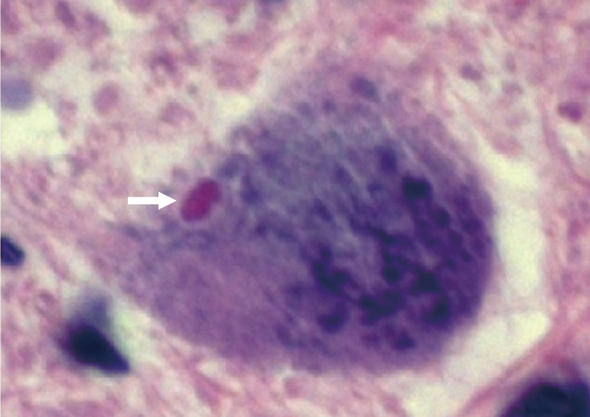 ⓔ図18-6-11　腰髄運動ニューロンのBunina小体 (HE染色) 残存前角細胞の細胞質内にエオジン好性封入体であるBunina小体を認める．筋萎縮性側索硬化症に特徴的である．