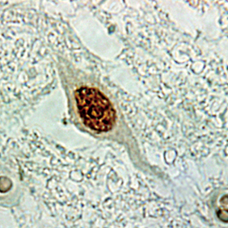 ⓔ図18-6-12　球脊髄性筋萎縮症の脊髄前角細胞 (抗ポリグルタミン免疫染色) 脊髄前角にある下位運動ニューロンの核内に変異アンドロゲン受容体の集積を認める．