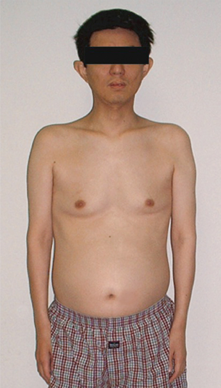 ⓔ図18-6-13　球脊髄性筋萎縮症患者の上半身 女性化乳房を認める．大胸筋や上肢近位部の筋萎縮もみられる．