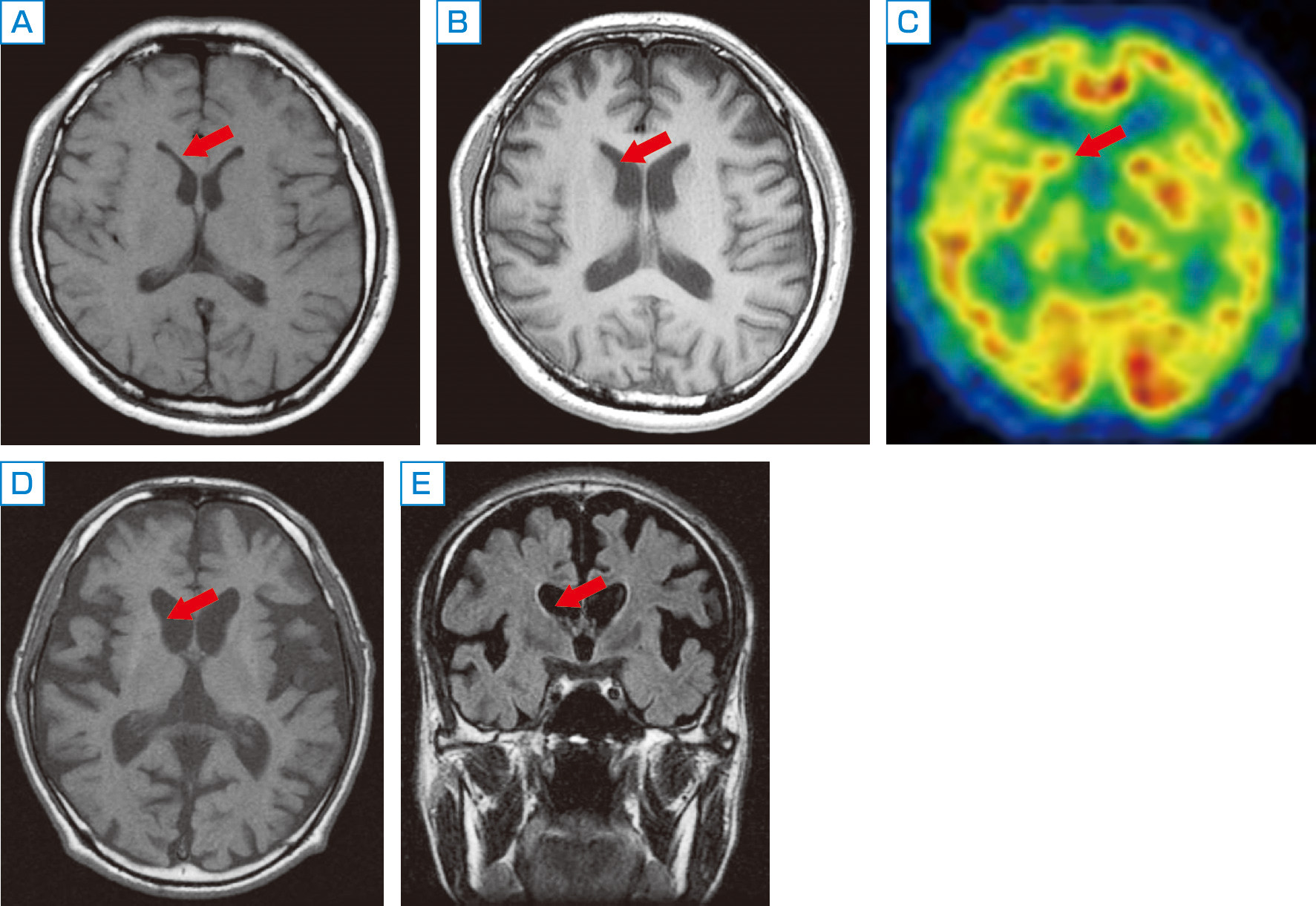ⓔ図18-6-5　Huntington病患者の画像検査 A～C：伸長CAGリピート45回の同一患者．A：31歳時のMRI，B：41歳時のMRI．C：同時期の99mTc ECD SPECT．31歳時は無症候，41歳は発症初期．MRIでは若干の尾状核の萎縮が認められる．SPECTでは，両側の前頭葉から側頭葉の軽ないし中等度の集積低下と，右側優位に両側線条体 (尾状核および被殻) の軽ないし中等度の集積低下が認められる． D, E：経過約10年，伸長CAGリピート40回，55歳の患者のMRI．D：水平断，E：冠状断．顕著な線条体 (特に尾状核) と大脳皮質の萎縮，脳室 (第3脳室，側脳室) の拡大が認められる．