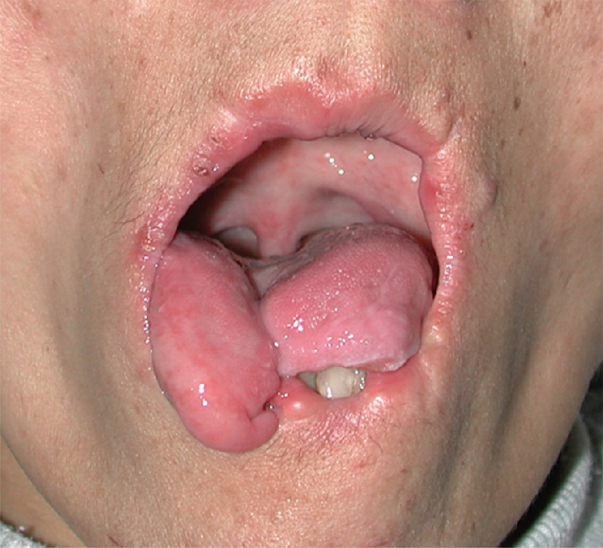 ⓔ図18-6-7　有棘赤血球舞踏病患者の自咬症 (Ueno S, Maruki Y, et al: Nat Genet, 2001; 28: 121–122) 