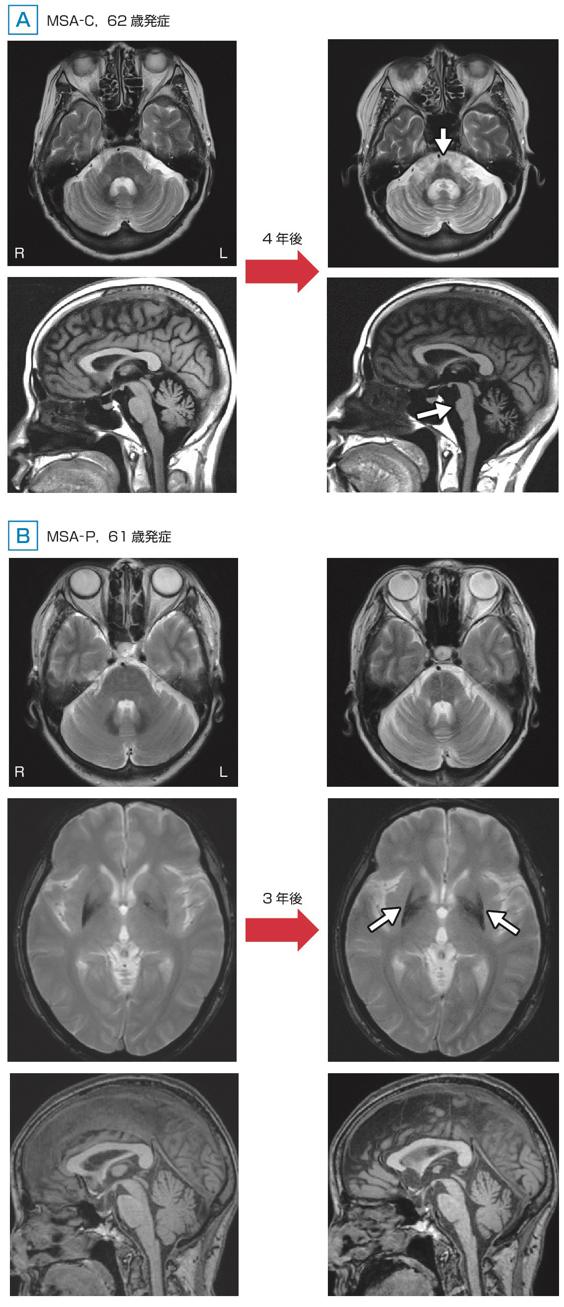 ⓔ図18-6-8　多系統萎縮症 (MSA–CおよびMSA–P) における頭部MRIの特徴 診断時に小脳性運動失調が前景に立った多系統萎縮症 (MSA–C) とParkinson症状が前景に立った多系統萎縮症 (MSA–P) の頭部MRI画像を示す．AのMSA–C患者 (62歳発症) では明らかな橋萎縮および小脳萎縮の進行を認める．4年経過後のT2強調画像水平断では中小脳脚の萎縮と中小脳脚の高信号域 (MCPサイン) および橋底部における十字徴候 (hot cross bunサイン，白矢印) を認める．T1強調画像矢状断では，橋底部の萎縮 (白矢印) は特に下方に強く認める．BのMSA–P患者 (61歳発症) ではT2＊強調画像水平断で右側優位の被殻背外側から外縁の低信号域を認め，3年経過後に明らかに進行し，左側の低信号域化も目立っている (白矢印)．また，橋萎縮および小脳萎縮も軽度に進行している．臨床的には左上下肢優位のParkinson症状で発症し，その後右上下肢にも進展した．