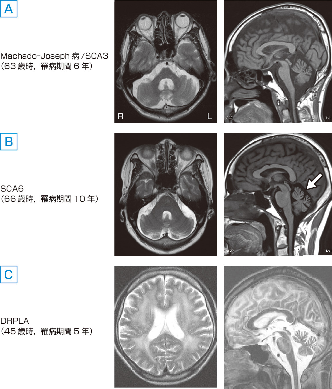 ⓔ図18-6-9　Machado–Joseph病/SCA3，SCA6およびDRPLAの頭部MRI所見 Machado–Joseph病/spinocerebellar ataxia type 3 (SCA3)，SCA6およびdentatorubral–pallidoluysian atrophy (DRPLA) 患者の頭部MRI所見を示す．図AのMachado–Joseph病/SCA3患者におけるT2強調画像水平断およびT1強調画像矢状断では，明らかな橋萎縮および小脳萎縮を認め，第4脳室が拡大している．図BのSCA6患者におけるT2強調画像水平断では，小脳半球および虫部の萎縮を認めるが，橋および中小脳脚の明らかな萎縮所見は認めない．T1強調画像矢状断では，橋底部は保たれるが虫部の上方の萎縮が顕著であることがわかる (白矢印)．図CのDRPLA患者におけるT2強調画像水平断では，大脳深部白質のびまん性高信号を認める．T2強調画像矢状断では，橋底部の高信号域も認め，虫部萎縮および第4脳室の拡大が目立っている．