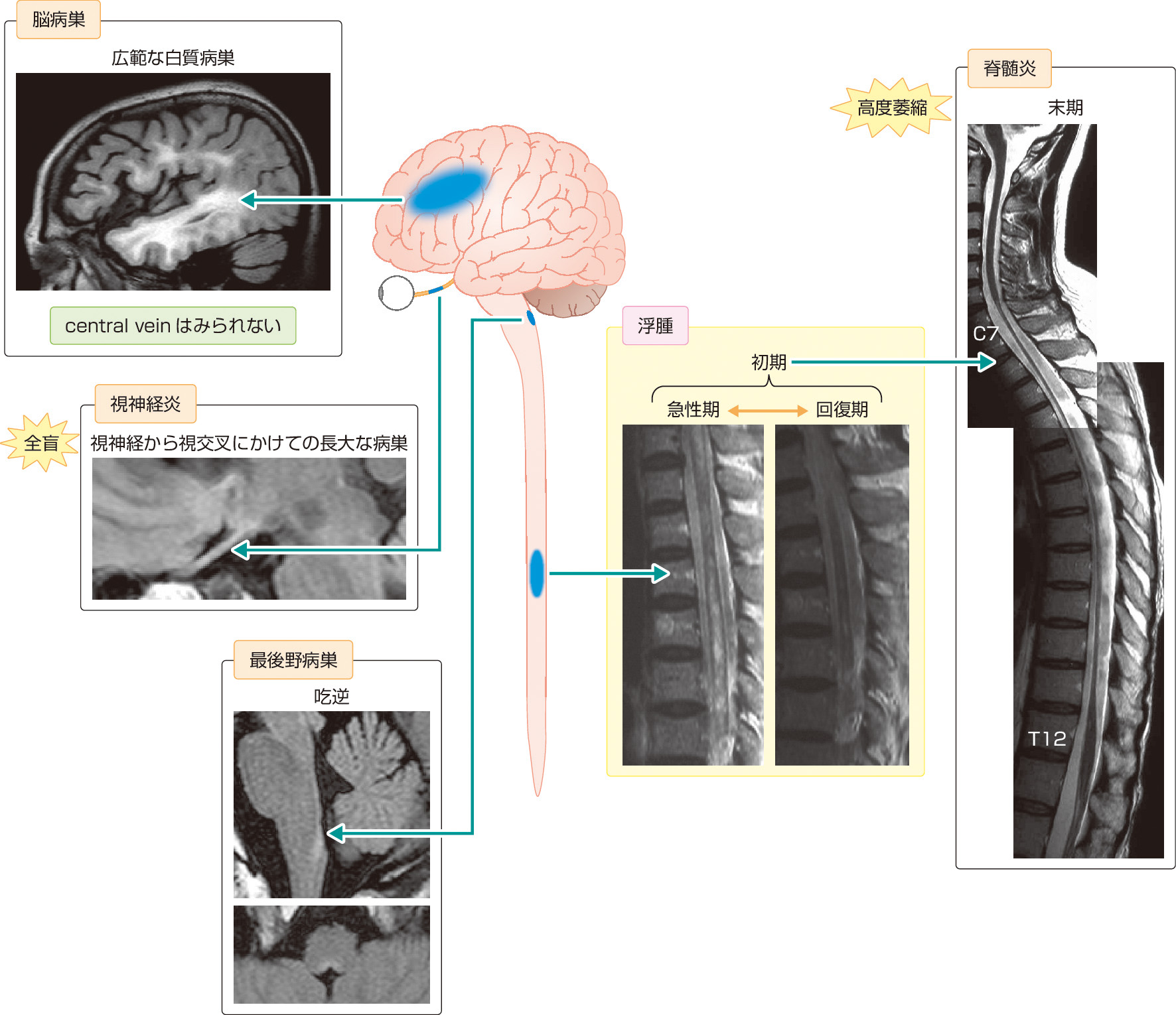 ⓔ図18-9-1　視神経脊髄炎でみられやすいMRI画像所見 脊髄MRI (T2強調画像) では，頸髄から胸髄にかけて，3椎体をこえる長大な病巣を認める．経過が長くなると，高度の脊髄萎縮を呈する．視神経から視交叉の長大な病巣を認めることもある．血液脳関門がない延髄最後野も侵されやすく，自己抗体が侵入しやすいためと考えられている．大脳白質に広範な病巣がみられることもある．