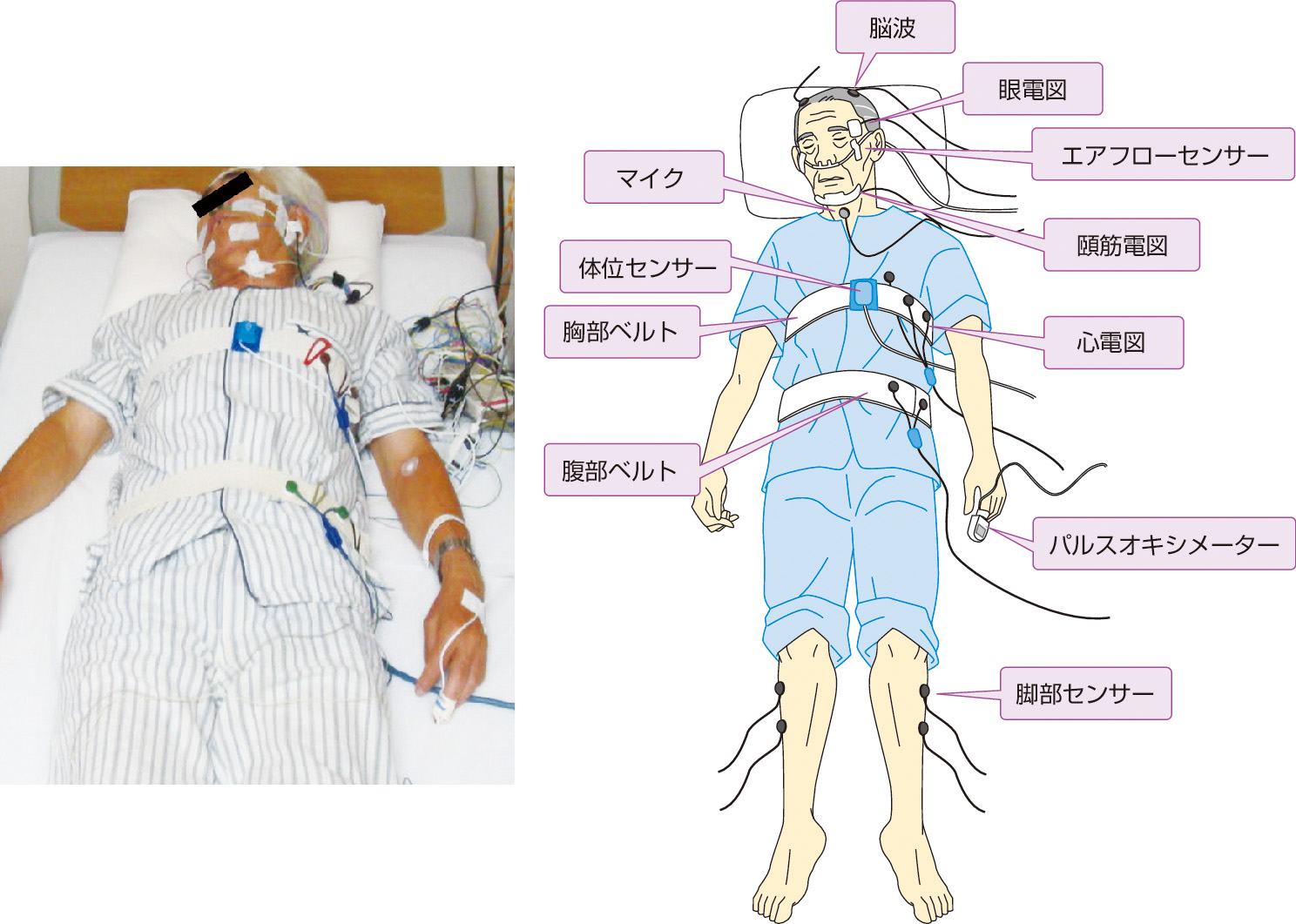 ⓔ図5-32-1　PSGで測定するパラメーター エアフローセンサー，胸部ベルト，腹部ベルトにより，閉塞性，中枢性，混合性無呼吸の分類が可能となる．マイクはいびきの有無を検知する．