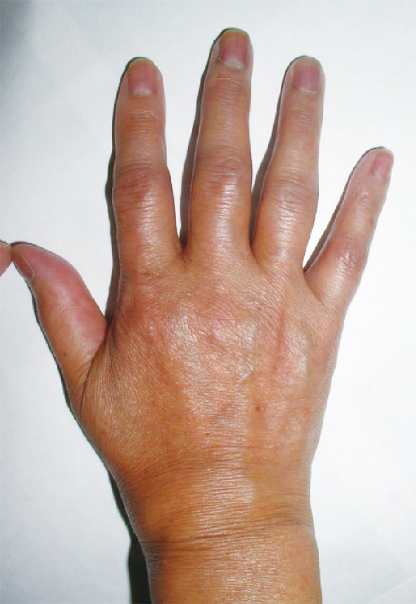 ⓔ図5-44-1　関節リウマチ患者の手 (画像提供：北海道せき損センター 竹田剛先生) 
