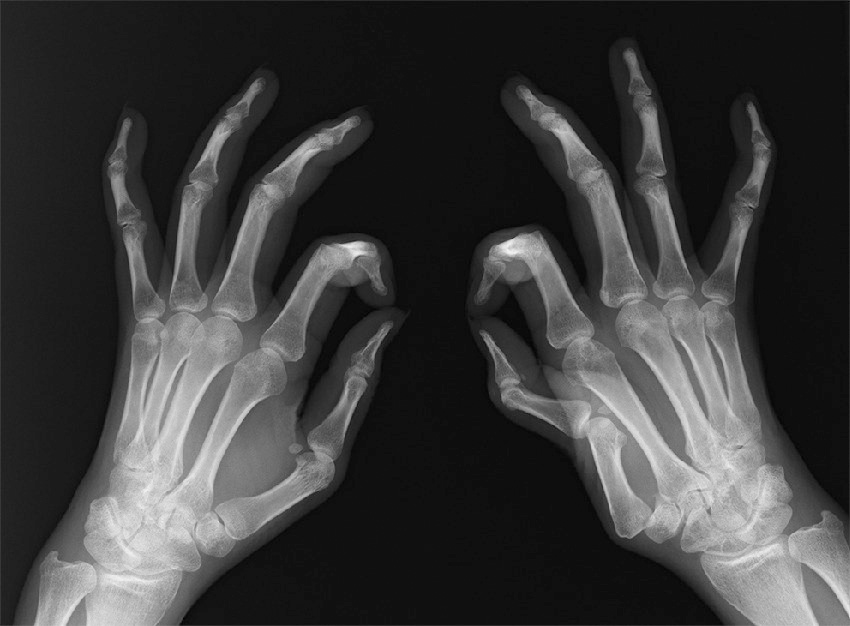 ⓔ図5-44-10　全身性エリテマトーデス患者 (35歳，女性) の単純X線写真 手指の変形を伴うが，骨病変は変形の程度に比してごく軽度か，みられない場合が多い (Jaccoud関節症)．