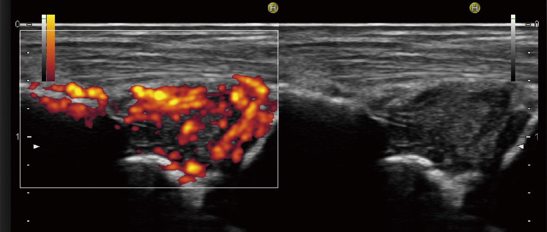 ⓔ図5-44-11　関節リウマチ患者の手関節超音波像 グレイスケール (右) で増殖滑膜および少量の関節液貯留を，パワードプラ (左) にて著明な血流の増加を認める．