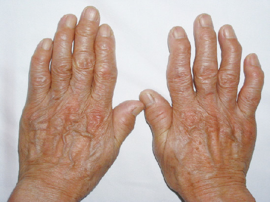 ⓔ図5-44-2　変形性関節症患者の手 (画像提供：北海道せき損センター 竹田剛先生) 