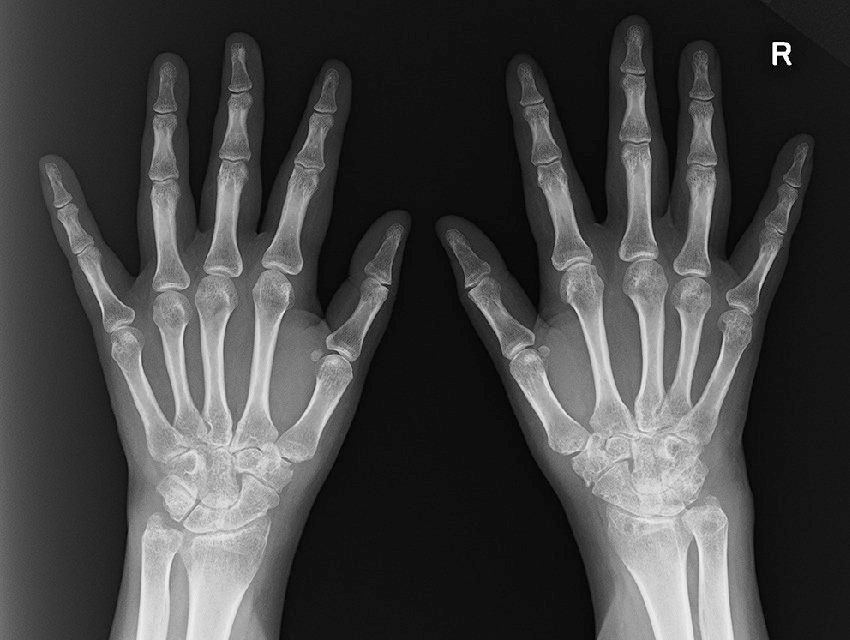 ⓔ図5-44-3　関節リウマチ患者の単純X線写真 手関節・手根骨およびMCP関節近位部に骨萎縮と骨嚢胞を認める．