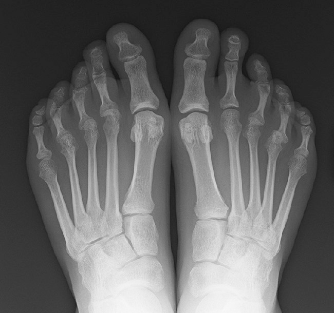 ⓔ図5-44-4　関節リウマチ患者の足趾単純X線写真 MTP関節にびらんが多発，一部に亜脱臼を認める．