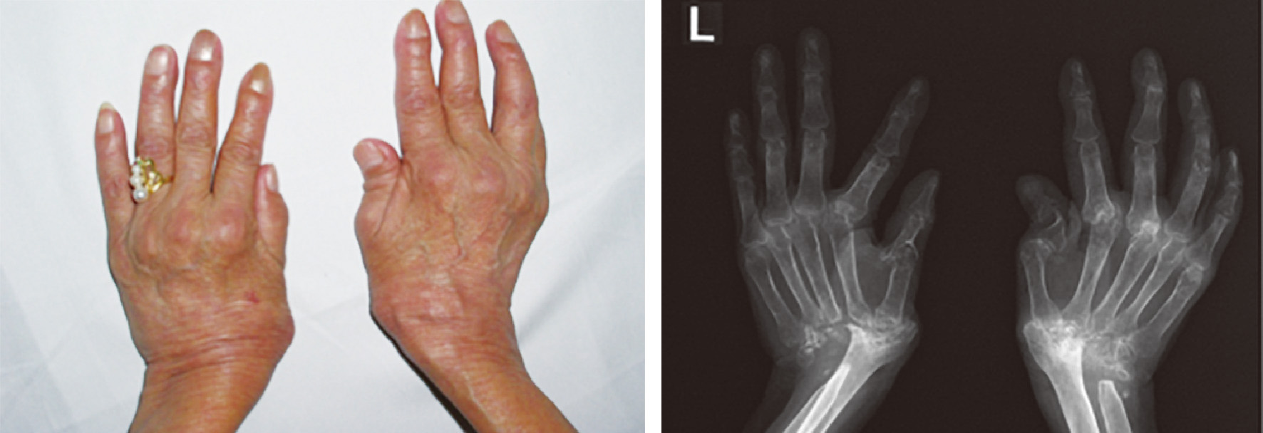 ⓔ図5-44-5　進行期関節リウマチ患者の手 (画像提供：苫小牧市立病院 堀田哲也先生) 