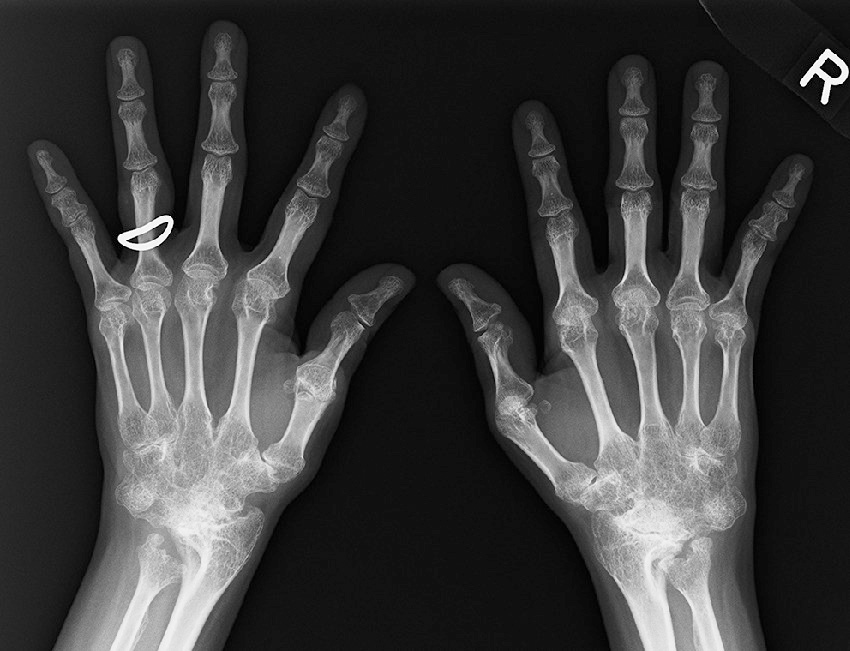 ⓔ図5-44-6　若年性特発性関節炎からのキャリーオーバー症例 手根骨は癒合，MCP関節は亜脱臼をきたしている．