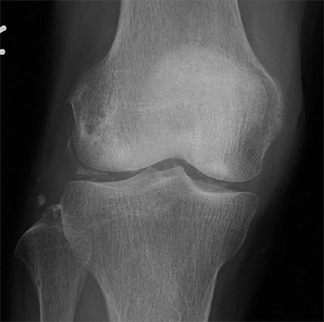 ⓔ図5-44-8　偽痛風患者の膝単純X線写真 関節裂隙に線状または点状の石灰化を認める．高齢者の単関節炎で頻度が高い．
