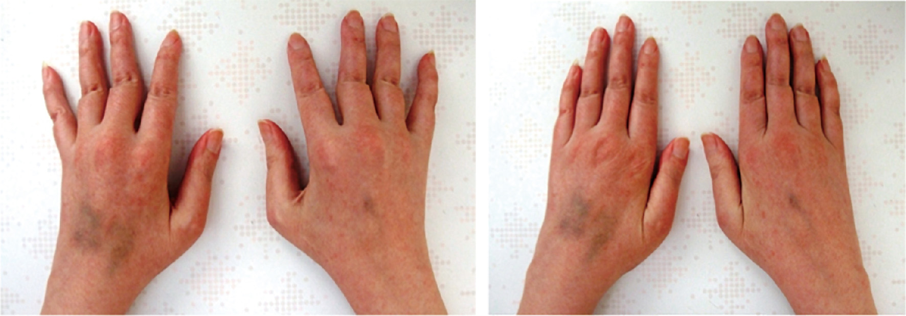 ⓔ図5-44-9　全身性エリテマトーデス患者にみられるJaccoud関節症 (画像提供：北海道大学病院 加藤将先生) 