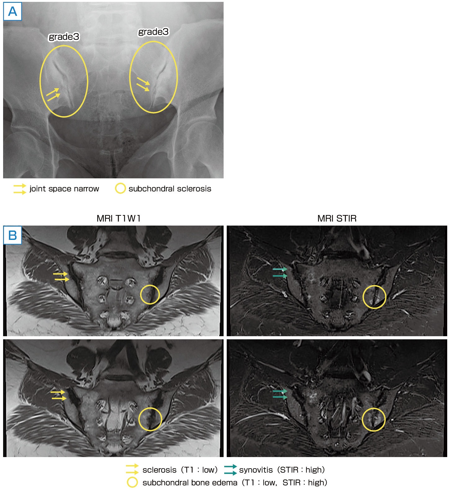 ⓔ図5-45-1　X線とMRIによるスクリーニング 56歳，女性．脊椎関節炎の疑い． A：単純X線画像，B：MRI画像．