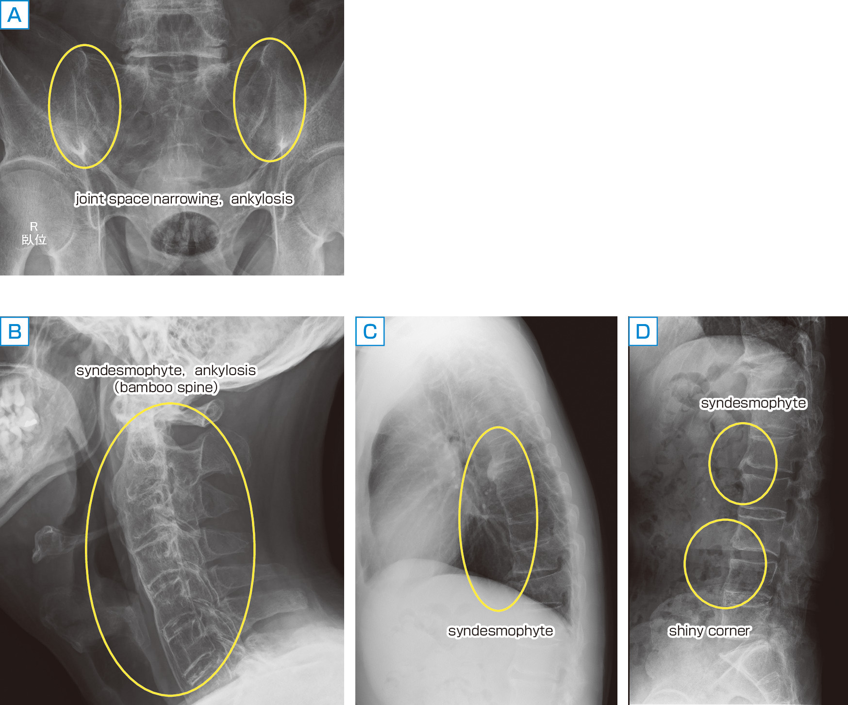 ⓔ図5-45-2　X線によるスクリーニング 46歳，男性．関節症候悪化． A：joint space narrowing (関節腔狭小化)，ankylosis (強直性)，B：syndesmophyte (靭帯骨棘)，ankylosis (bamboo spine (竹様脊椎))，C：syndesmophyte (靭帯骨棘)，D：shiny corner (硬化像)