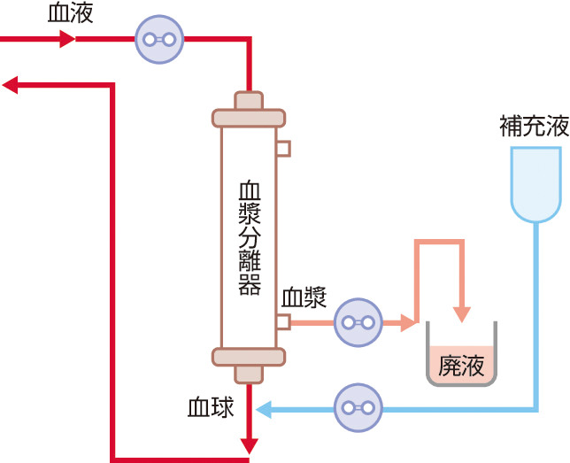 ⓔ図6-1-1　単純血漿交換法 (PE) の模式図 