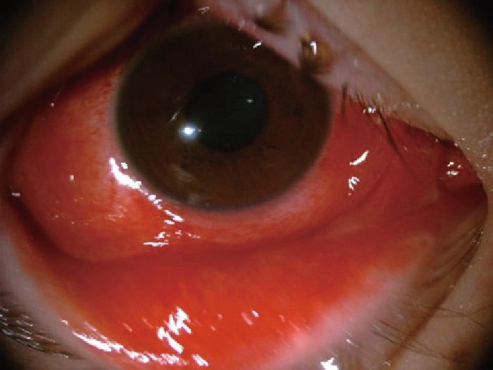 ⓔ図7-10-1　流行性角結膜炎 (Kaneko H, Hanaoka H, et al: Jpn J Infect Dis, 2020; 73: 316–319) 