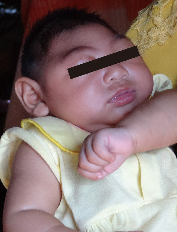 ⓔ図7-10-9　小頭症 