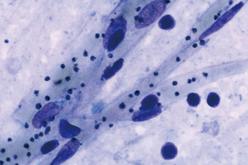 ⓔ図7-11-2　重症マラリア患者死亡例の脳組織Giemsa染色スタンプ標本 毛細血管のなかに感染赤血球 (Giemsaで濃く染まった粒状のものが原虫) が閉塞している．