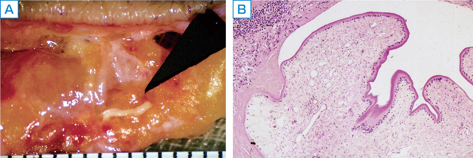 ⓔ図7-14-2　マンソン孤虫症患者の皮膚生検 A：皮膚組織中にみられたマンソン孤虫 (黒三角の先)．B：HE染色による病理所見．