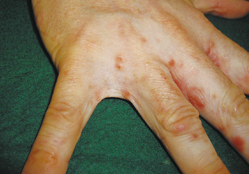 ⓔ図7-15-2　疥癬の臨床像 手指，指間部に紅色丘疹が多数，認められる．