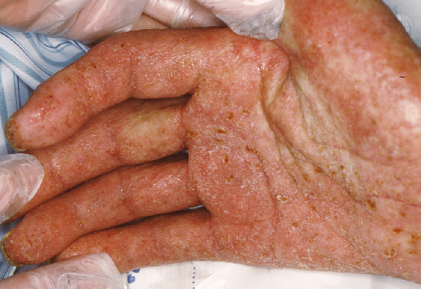ⓔ図7-15-4　角化型疥癬の臨床像 手掌に角化を伴う落屑性紅斑，痂皮を認める．