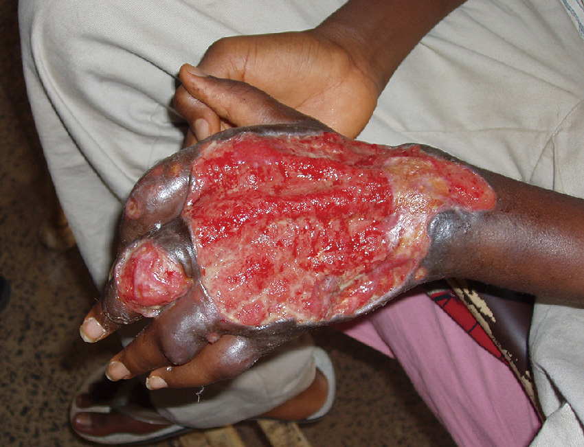 ⓔ図7-2-12　Buruli ulcer (https://www.who.int/buruli/photos/Large_ulcer_Nigeria_hand_small.jpg) Mycobacteriumの感染による皮膚潰瘍．アフリカ西部やアフリカ中央部の国々からの症例報告が多い．早期発見と早期治療 (抗生物質による) が瘢痕，変形の防止に繋がる．