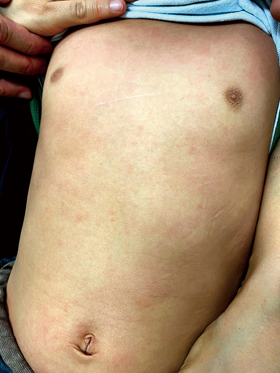 ⓔ図7-3-1　A群連鎖球菌による点状丘疹 (東京医科大学病院小児科・思春期科 山中岳先生より提供)