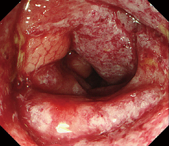 ⓔ図7-3-11　腸管出血性大腸菌O26による出血性大腸炎の内視鏡所見 びらんや出血がみられ，著明な浮腫による管腔の狭小化を呈している．