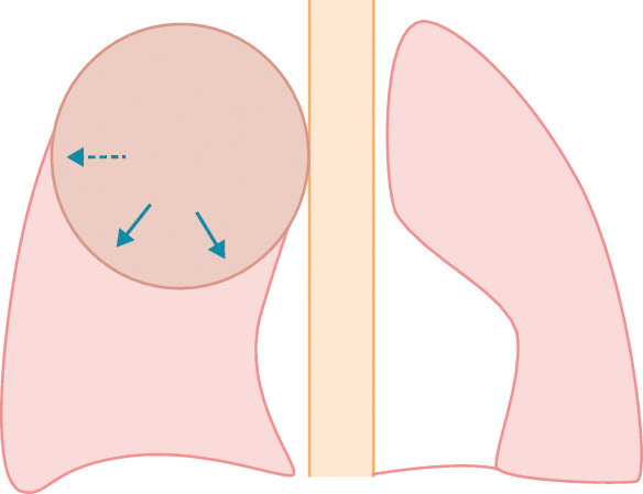 ⓔ図7-3-12　bulging fissure sign 右上葉の肺炎で肺胞内に滲出液が充満することにより，肺葉が拡張し葉間を圧排し下に凸 (実線矢印) となる．肺容積は増大 (破線矢印) する．