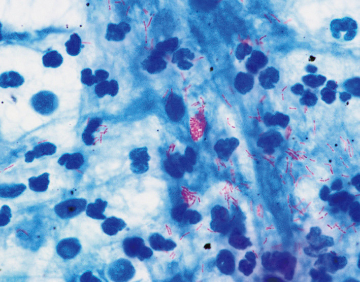 ⓔ図7-4-1　喀痰塗抹 (Ziehl–Neelsen染色，陽性) 赤紫に染まった桿菌．1つの視野でこれだけ見られることは3＋に相当し，排菌量がきわめて多いと考えられる．