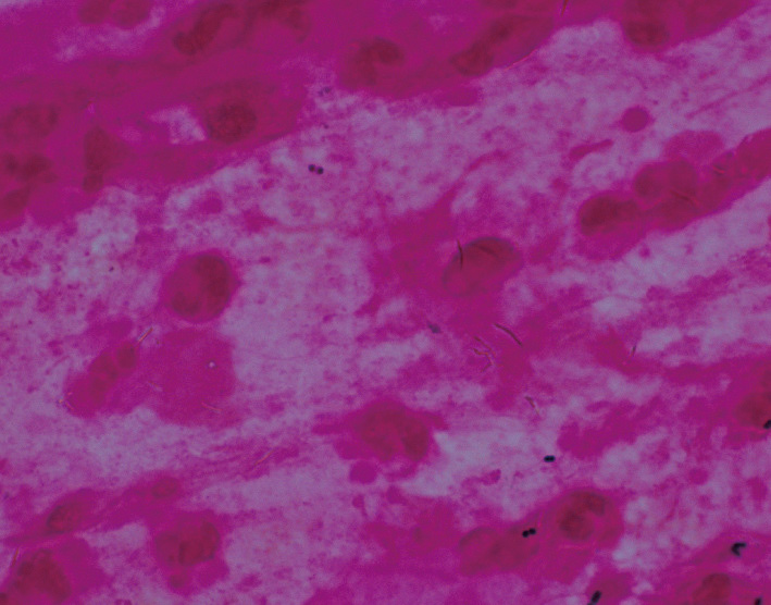 ⓔ図7-4-2　喀痰塗抹 (Gram染色) 結核菌にはミコール酸が含まれるため，Gram染色では染まらない．しかし，顕微鏡で焦点を合わせようとすると，白く抜けたり，黒くなったりして，染色が不十分な菌を見つけることがある．経験のある検査技師は抗酸菌 (結核菌を含む) の存在を疑い，Ziehl–Neelsen染色を行う．