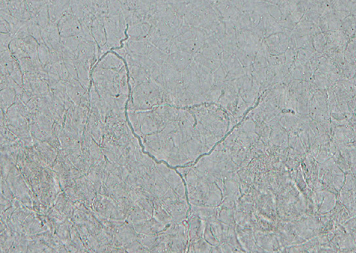 ⓔ図7-5-10　足白癬のKOH直接鏡検査所見 Trichophyton interdigitale強拡大像．分節を有する菌糸と螺旋を思わせるうねるような菌糸を認める．