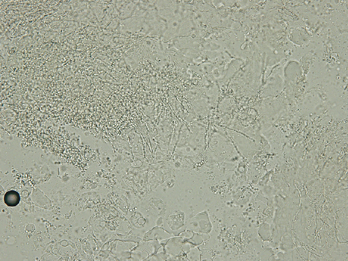 ⓔ図7-5-15　爪白癬のKOH直接鏡検査所見 Trichophyton rubrum．多数の分節を有する菌糸と数珠のような分節の連なる分節分生子を認める．