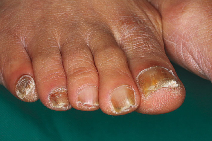 ⓔ図7-5-16　爪白癬および足白癬の臨床 爪甲の肥厚混濁を認める．