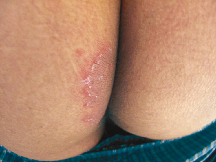 ⓔ図7-5-17　左臀部の体部白癬の臨床 境界明瞭な落屑性環状紅斑．