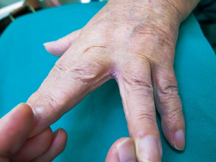 ⓔ図7-5-20　カンジダ性指間びらん症の臨床 指間の浸軟したびらんと紅斑を認める．