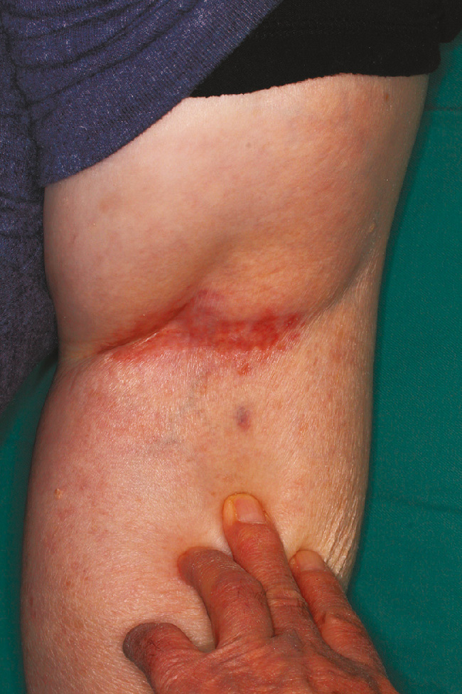 ⓔ図7-5-22　膝窩に生じたカンジダ性間擦疹の臨床像 